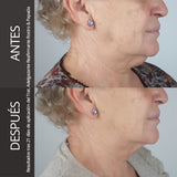 Firming Slimming Treatment for Face & Double Chin - Eliminates volume in the face and neck and prevents sagging