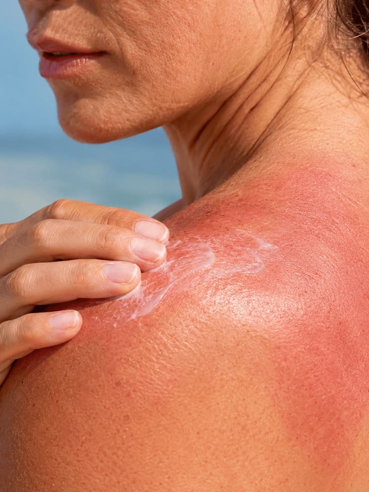 AFTER SUN con Aloe Vera