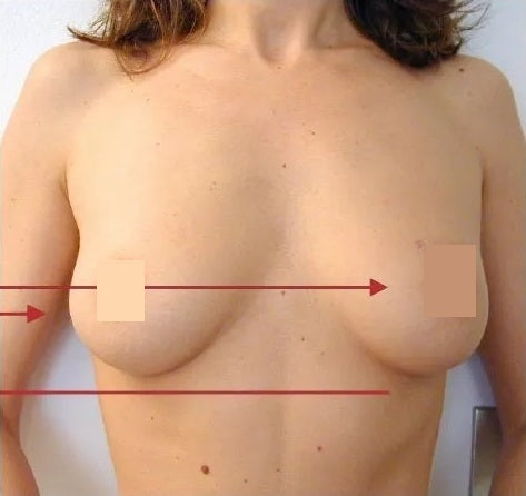 Tratamiento de prueba para mejorar el pecho