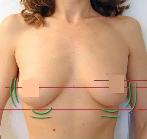 Tratamiento para la belleza del pecho