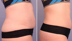 Tratamiento Reductor Quemagrasas - resultados antes y después